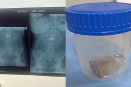 Pakistani Doctors Remove Iron Lock from Woman’s Stomach Without Surgery