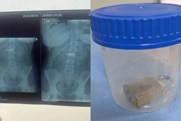 Pakistani Doctors Remove Iron Lock from Woman’s Stomach Without Surgery